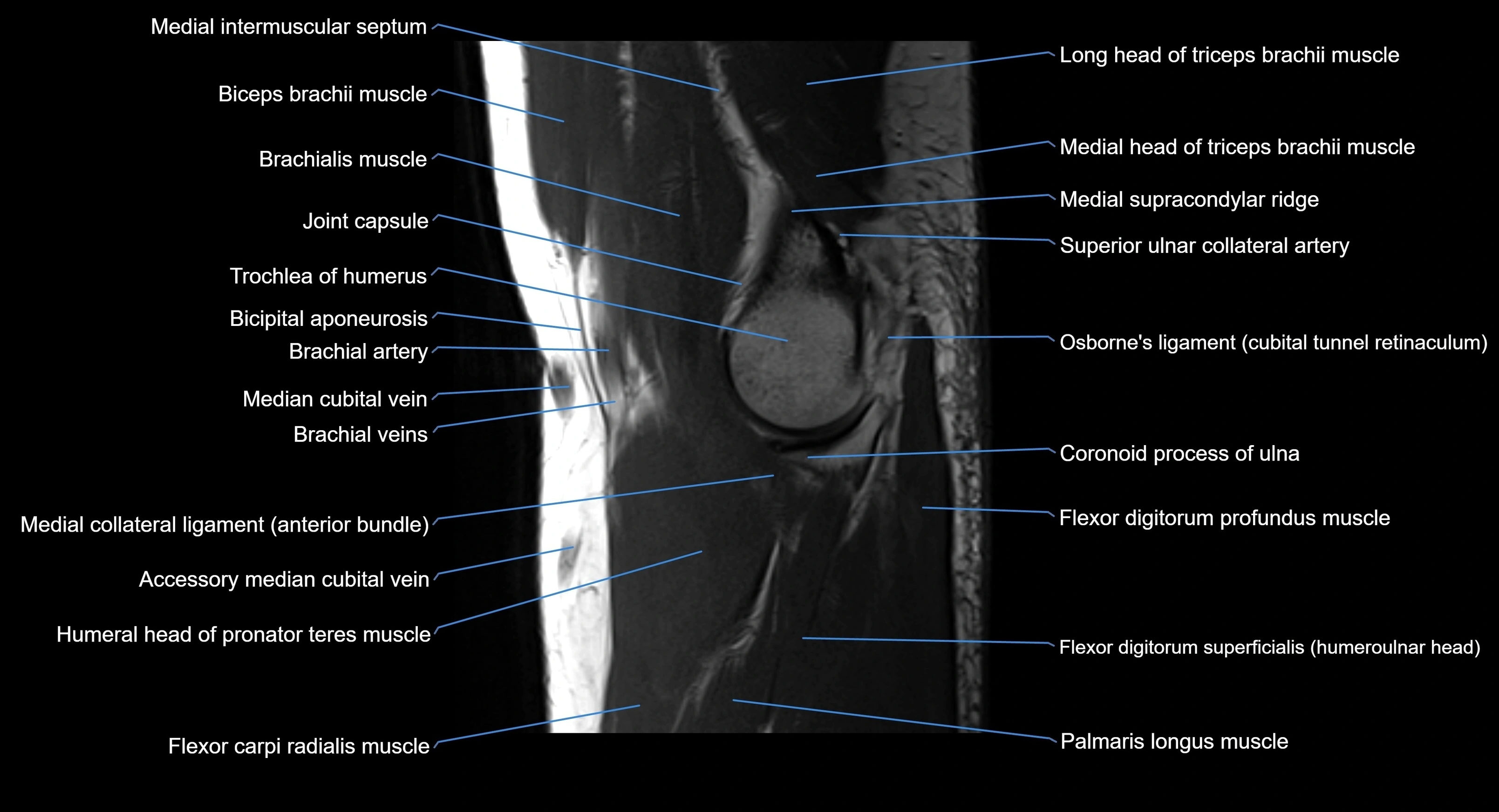 MRI elbow joint  sagittal cross sectional anatomy 3T  radiology  image-img-00001-00010.webp